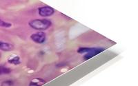 Basidiobolus Invading Human Tissue HD Metal print