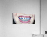 Braces Acrylic Print