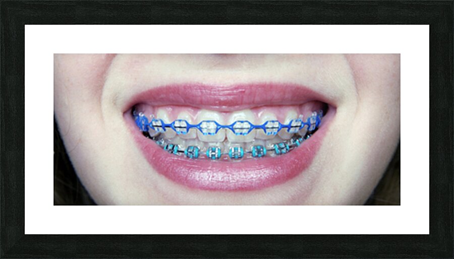 Braces Picture Frame print