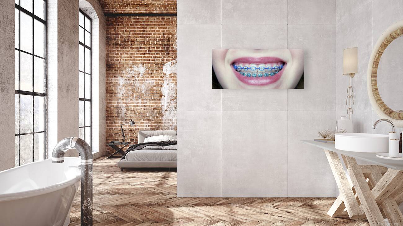 Braces Reproduction