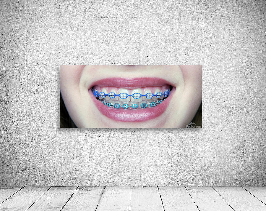 Braces Wall Preview
