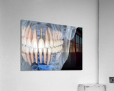 Teeth recovery with implants x-ray view. Acrylic Print