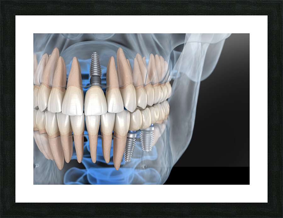 Teeth recovery with implants x-ray view. Picture Frame print