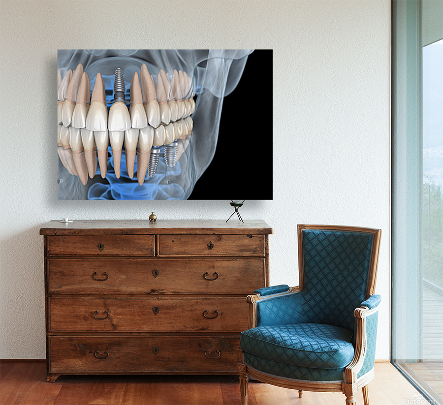 Teeth recovery with implants x-ray view. Reproduction