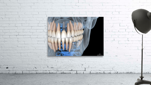 Teeth recovery with implants x-ray view. Wall Preview