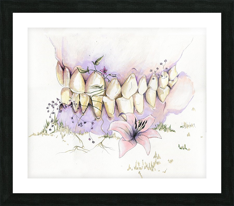 tooth decay Picture Frame print