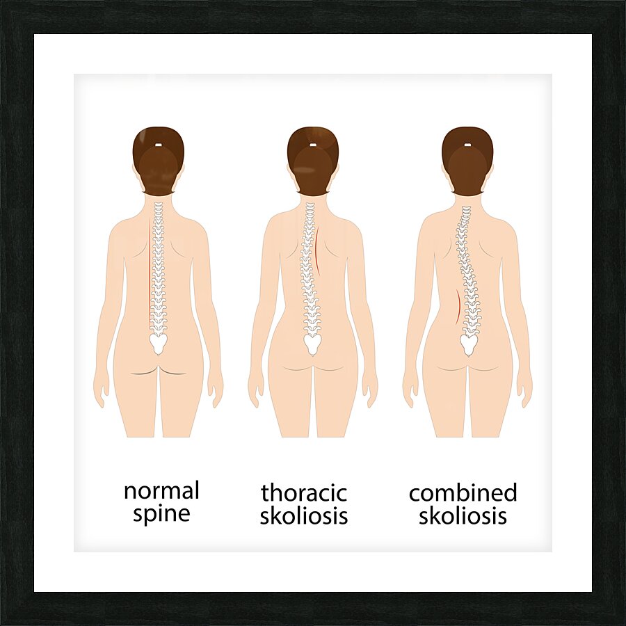 Spinal deformity Picture Frame print
