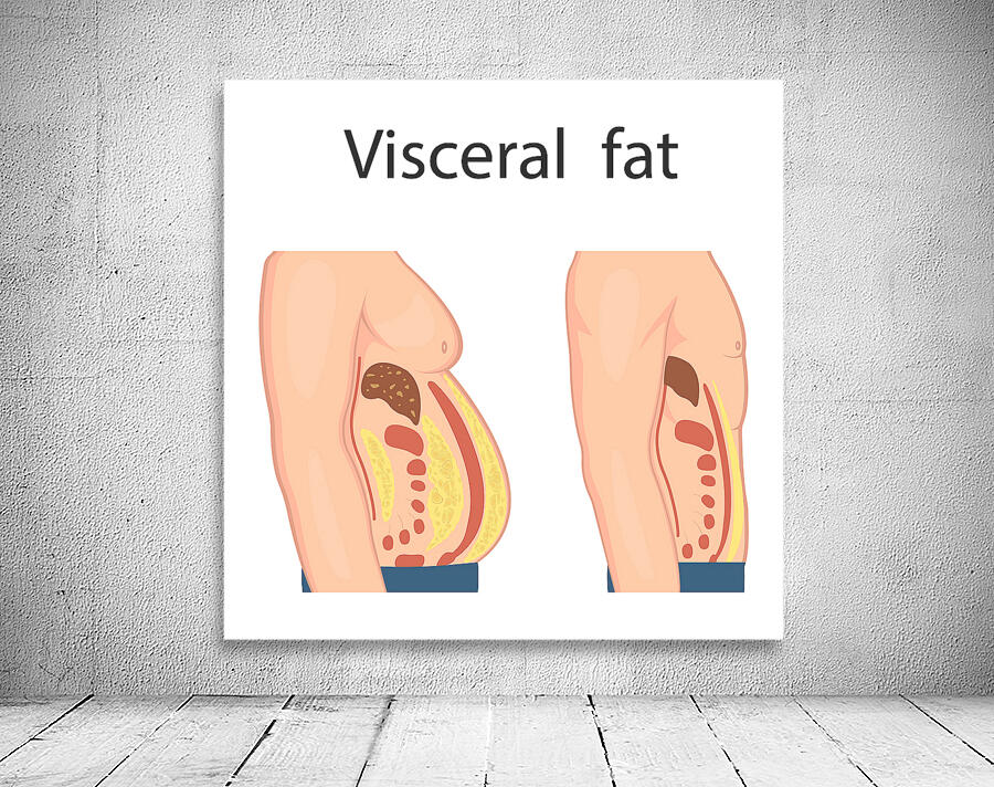 Visceral fat Wall Preview