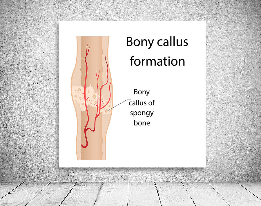Bony callus formation  Wall Preview