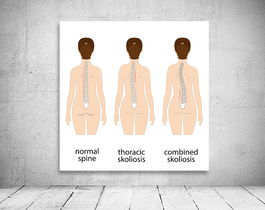 Spinal deformity Wall Preview