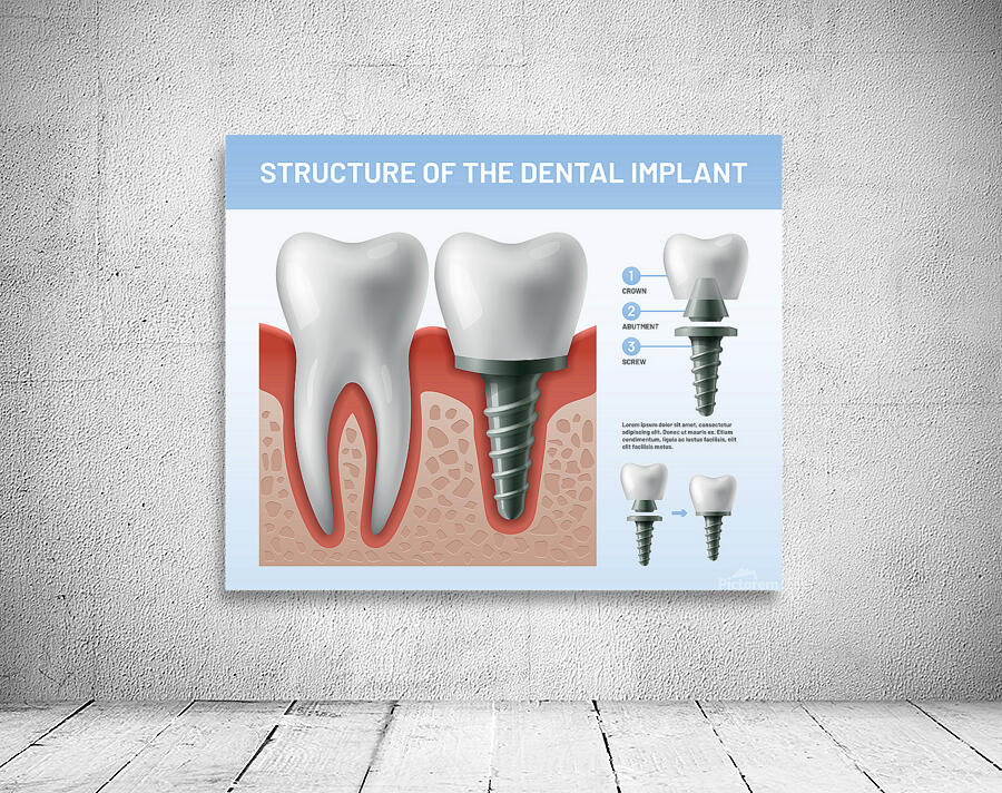 Structure of the Dental implant by Point Art Wall Art